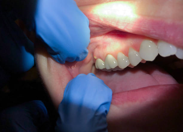 Best Cracked Tooth Emergency Dentist  in Hueytown, AL