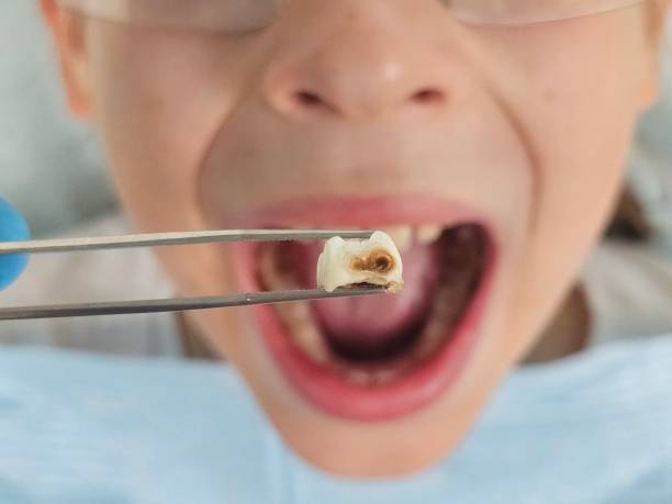 Best Dentist for Tooth Abscess  in Hueytown, AL